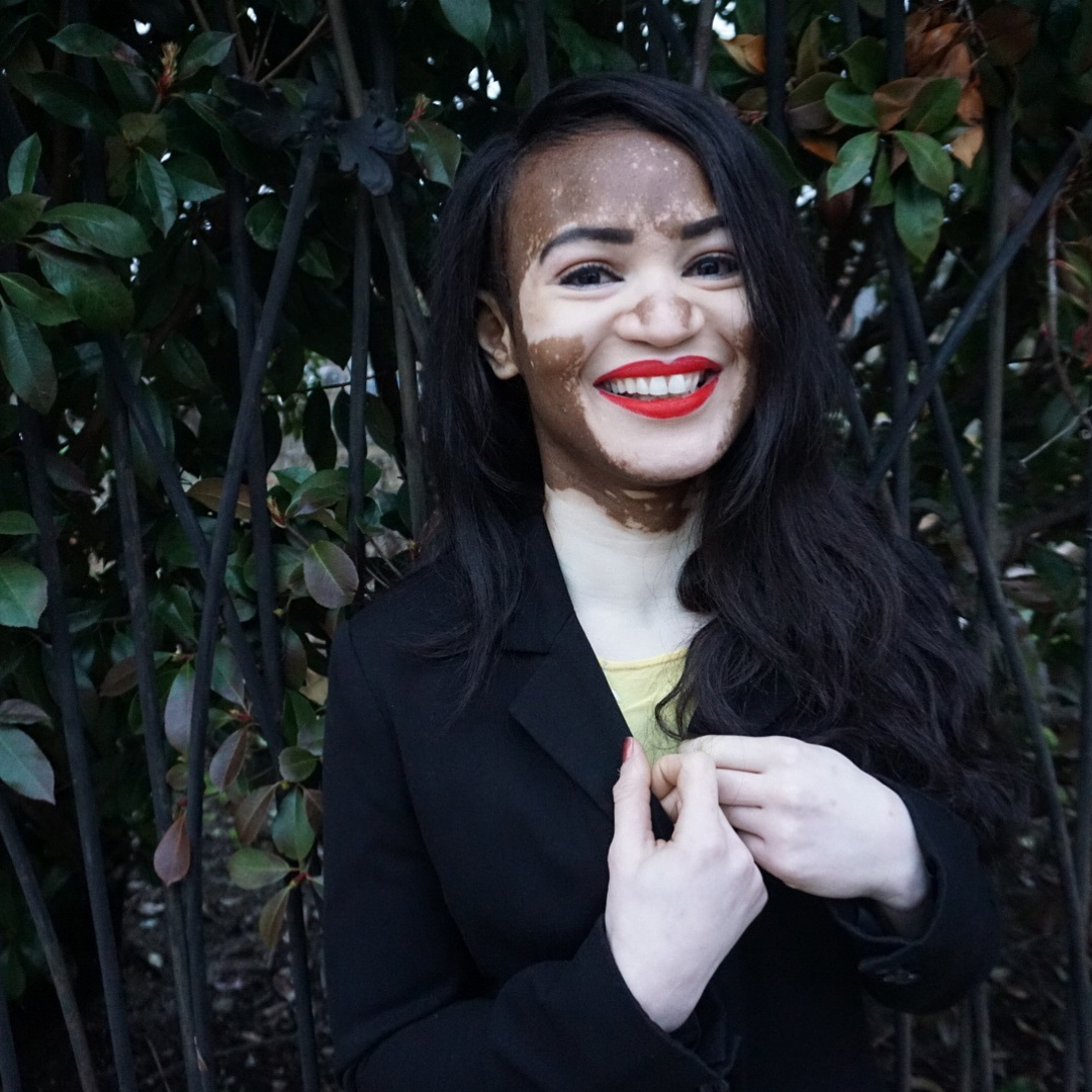 tình yêu của cô gái mắc bệnh bạch biến ảnh 3 tinh yeu cua co gai mac benh bach bien anh 3