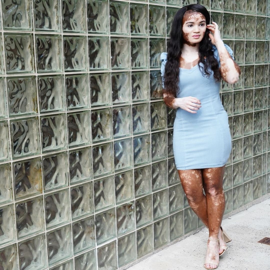 tinh yeu cua co gai mac benh bach bien anh 6