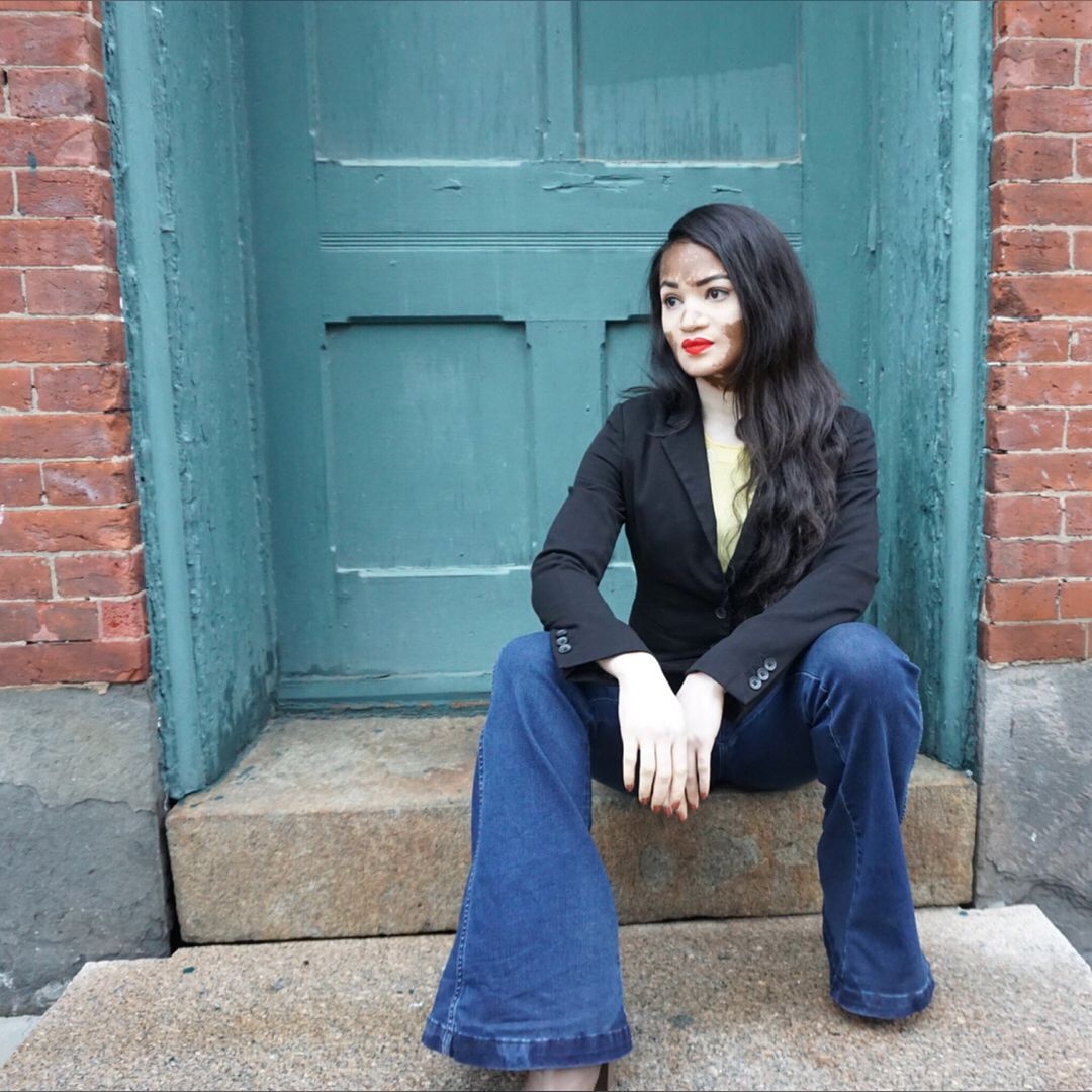 tình yêu của cô gái mắc bệnh bạch biến ảnh 4 tinh yeu cua co gai mac benh bach bien anh 4