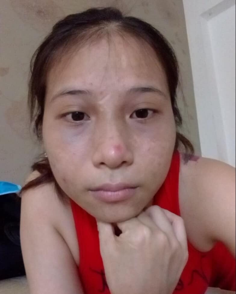 Hạnh phúc của cô gái bị bỏng mặt do xông hơi ảnh 1 Hanh phuc cua co gai bi bong mat do xong hoi anh 1