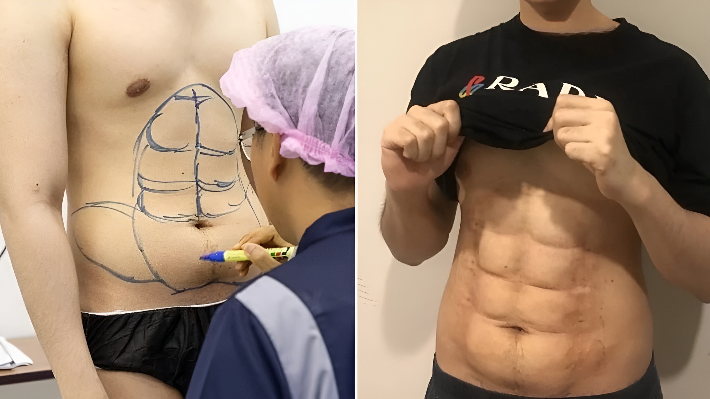 Phau thuat 'khac bung' 6 mui vi luoi tap gym hinh anh