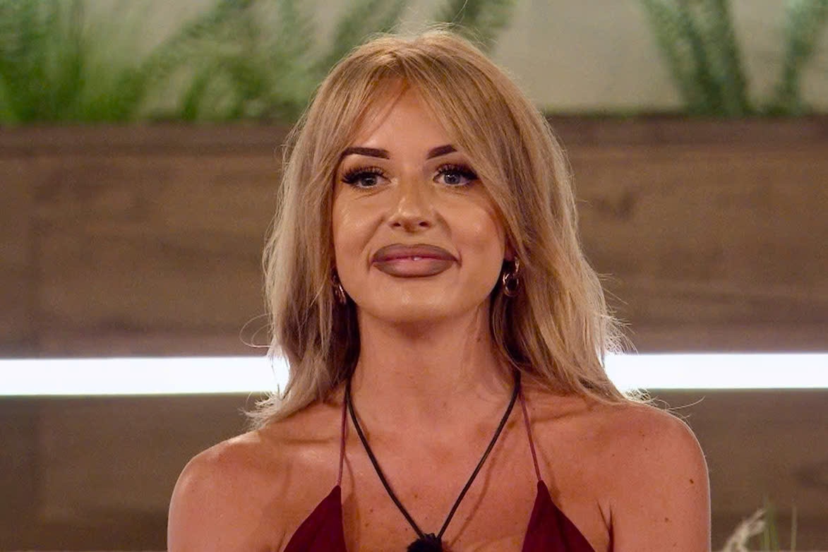 Khuon mat nhu 'toa nha bi sap' sau khi tiem tan filler hinh anh