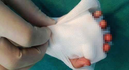 Noi lien bo phan bi dut lia - ky thuat vi phau dinh cao hinh anh