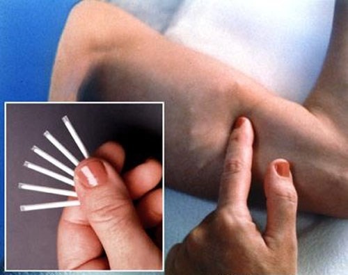 Cay que tranh thai: Bien phap moi, uu viet hon? hinh anh