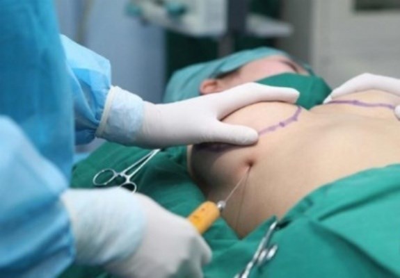 Bom nguc bang mo tu than: Bi quyet lam dep hay su lua doi? hinh anh