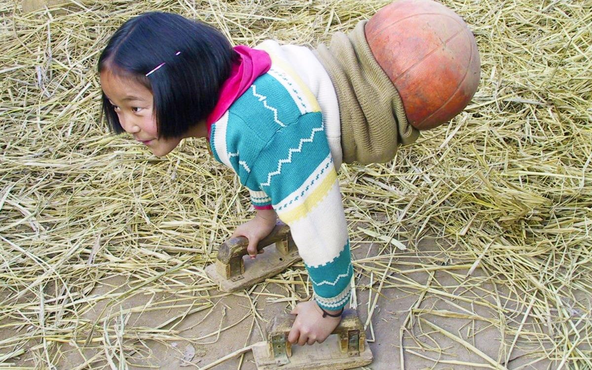 Cuoc doi ky dieu cua 'co gai bong ro' mat chan sau tai nan hinh anh