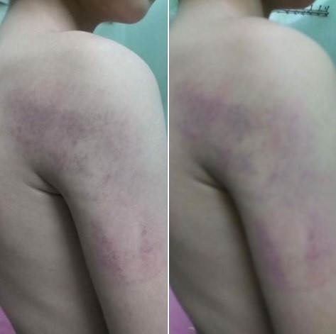 cô giáo đánh học sinh bầm tím người ảnh 1 co giao danh hoc sinh bam tim nguoi anh 1