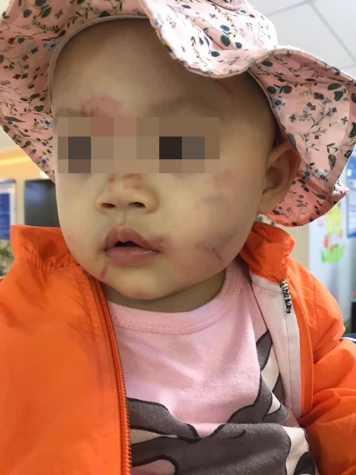 trẻ mầm non bầm tím mặt mũi ảnh 1 tre mam non bam tim mat mui anh 1