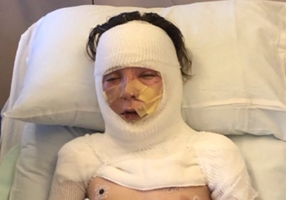 Nam sinh bi bong nang vung mat sau thi nghiem 'con ran den' hinh anh