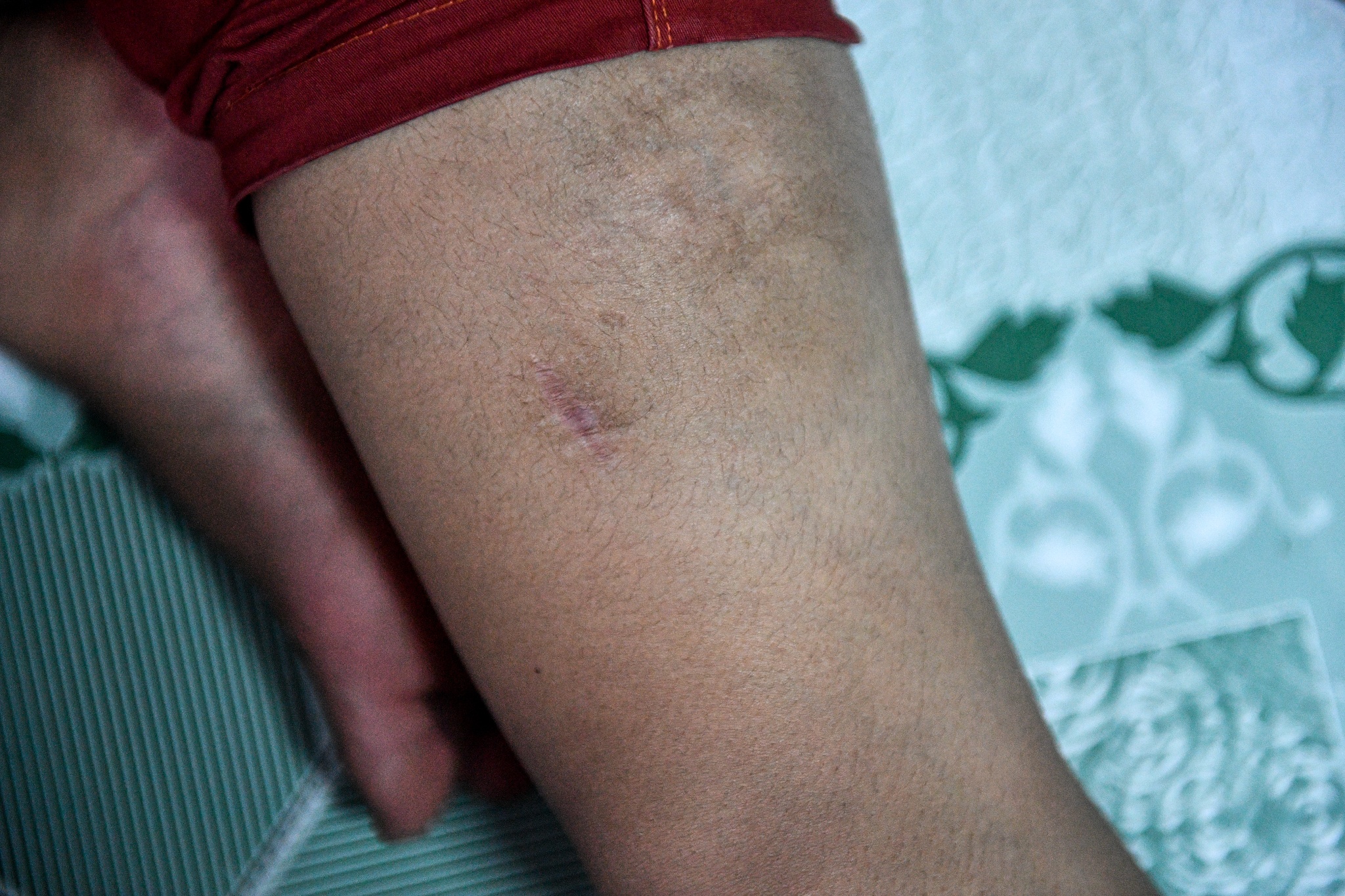 VO SI 11 TUOI MAC UNG THU anh 13