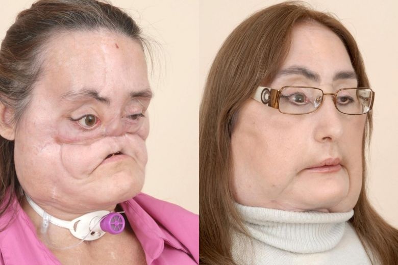 nguoi dau tien ghep mat o My qua doi anh 1