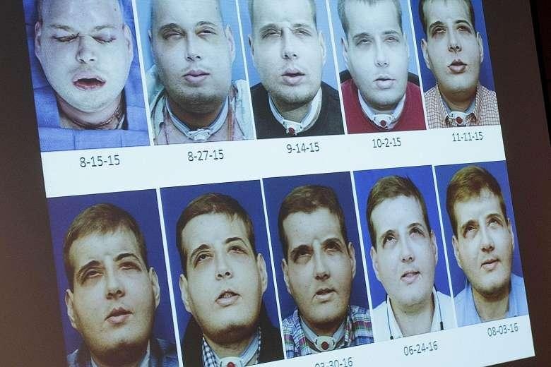 nguoi dau tien ghep mat o My qua doi anh 8