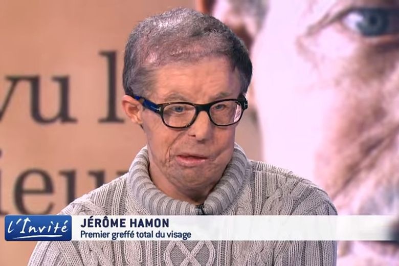 nguoi dau tien ghep mat o My qua doi anh 4