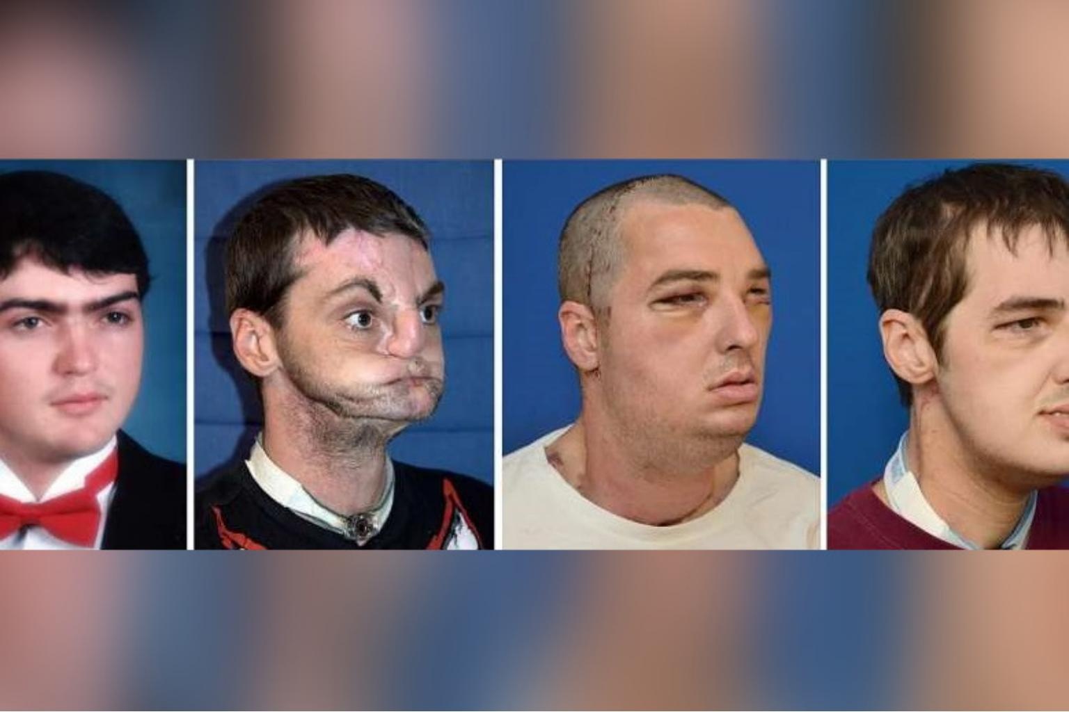 nguoi dau tien ghep mat o My qua doi anh 7