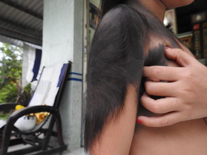 Hypertrichosis ảnh 2 Hypertrichosis anh 2