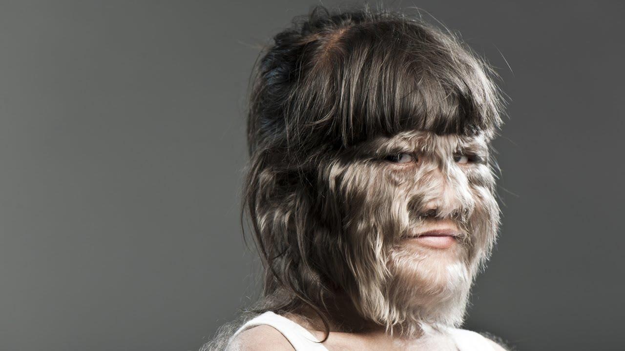 Hypertrichosis ảnh 1 Hypertrichosis anh 1