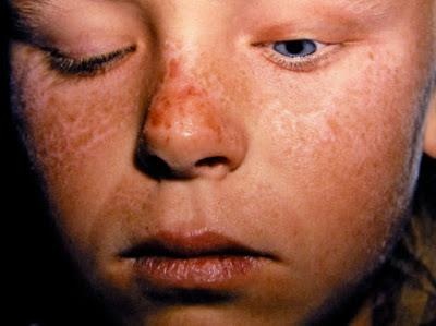 Benh ma ca rong anh 2