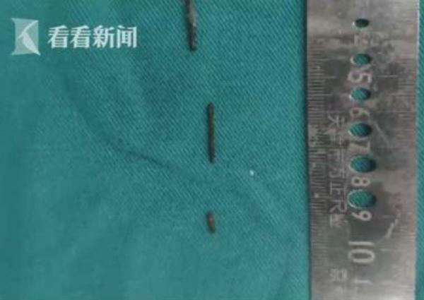 Phẫu thuật lấy kim ảnh 2 Phau thuat lay kim anh 2