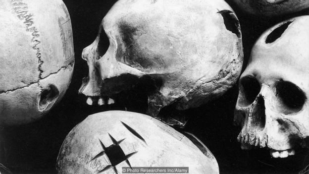 kỹ thuật khoan hộp sọ ảnh 2 ky thuat khoan hop so anh 2