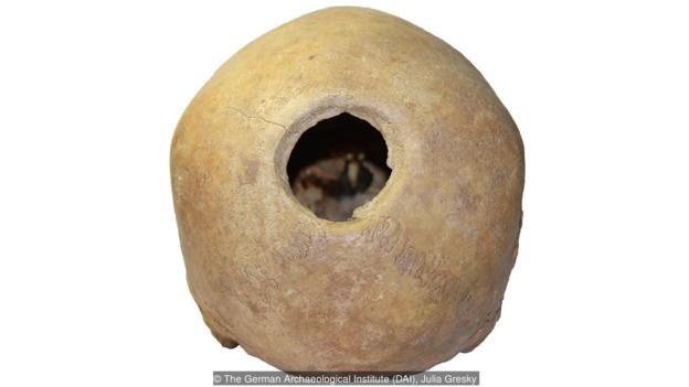 khoan hộp sọ ảnh 2 khoan hop so anh 2