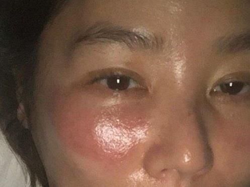 Kim Sung Ryung bi bong rat vi dap mat na qua dem hinh anh