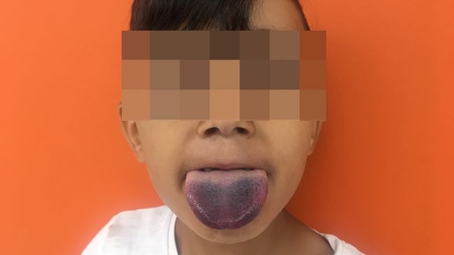 Cau be 7 tuoi phai nhap vien vi luoi mac ket trong co chai hinh anh
