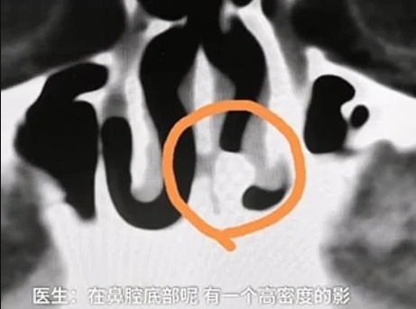 răng lạc vào mũi ảnh 1 rang lac vao mui anh 1