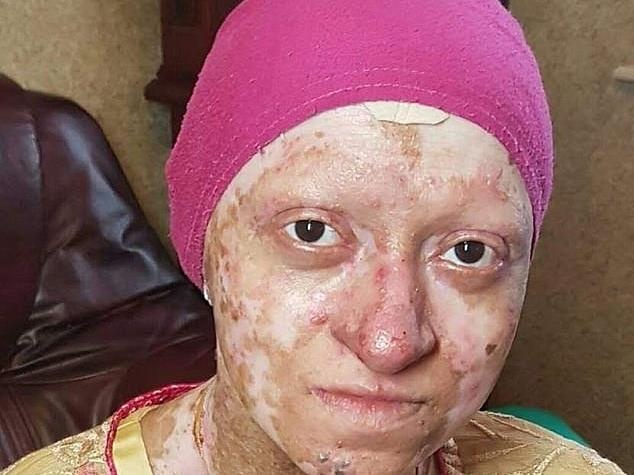 Co gai co lan da mong nhu giay, phong rop lo loet moi dem hinh anh