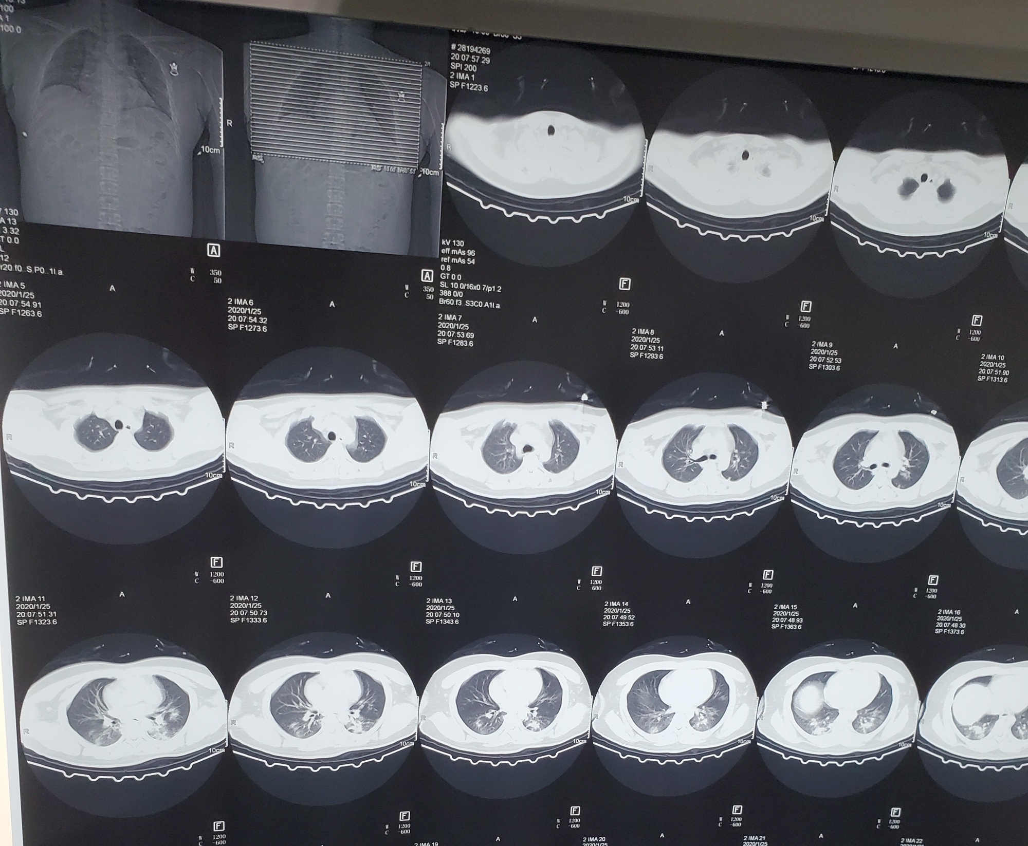 virus corona lây lan ảnh 2 virus corona lay lan anh 2