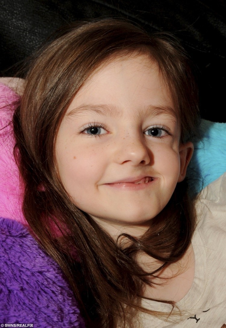 Hoi chung Parry-Romberg anh 1