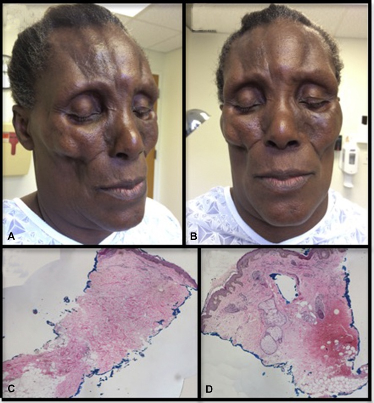 Hoi chung Parry-Romberg anh 3