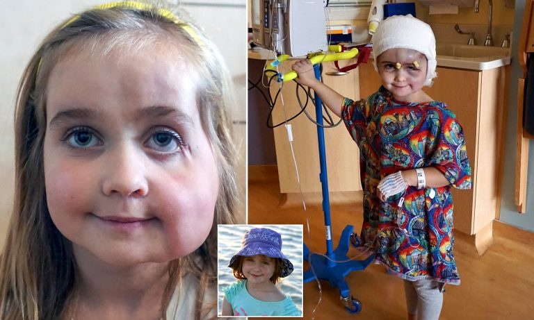 Hoi chung Parry-Romberg anh 2