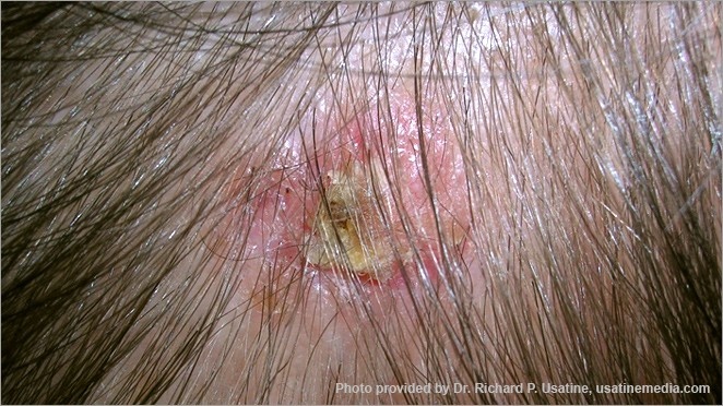 hinh anh ung thu da anh 6