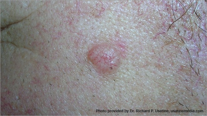 hinh anh ung thu da anh 7