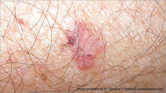 hinh anh ung thu da anh 10