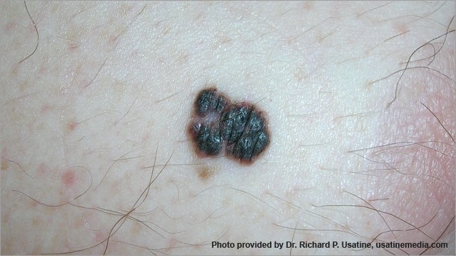 hinh anh ung thu da anh 15