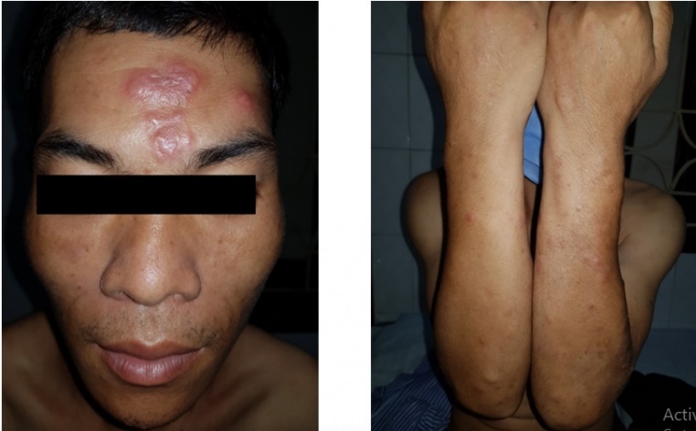 Bệnh hủi xuất hiện ảnh 1 Benh hui xuat hien anh 1