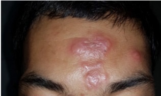 Benh phong xuat hien o Lang Son hinh anh