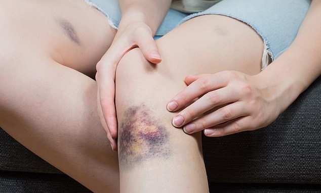 dau hieu ung thu mau anh 2