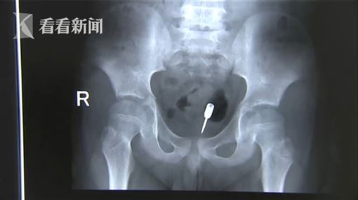 phi tieu chui vao hau mon anh 1