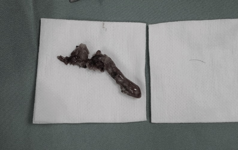 Be trai 5 tuoi bi nhiem trung ruot thua vi hoc xuong ca hinh anh