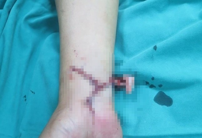 Suyt mat ban tay vi bi khi tan cong hinh anh