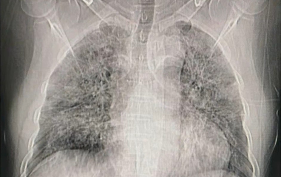 Benh nhan o Hai Duong ton thuong phoi rat nang hinh anh