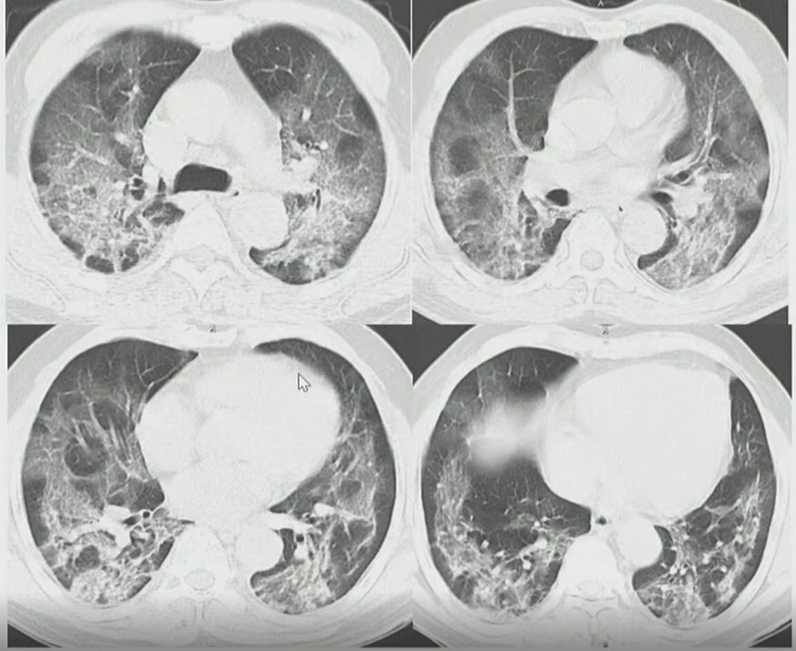 Hình ảnh phổi của BN867 ảnh 2 Hinh anh phoi cua BN867 anh 2