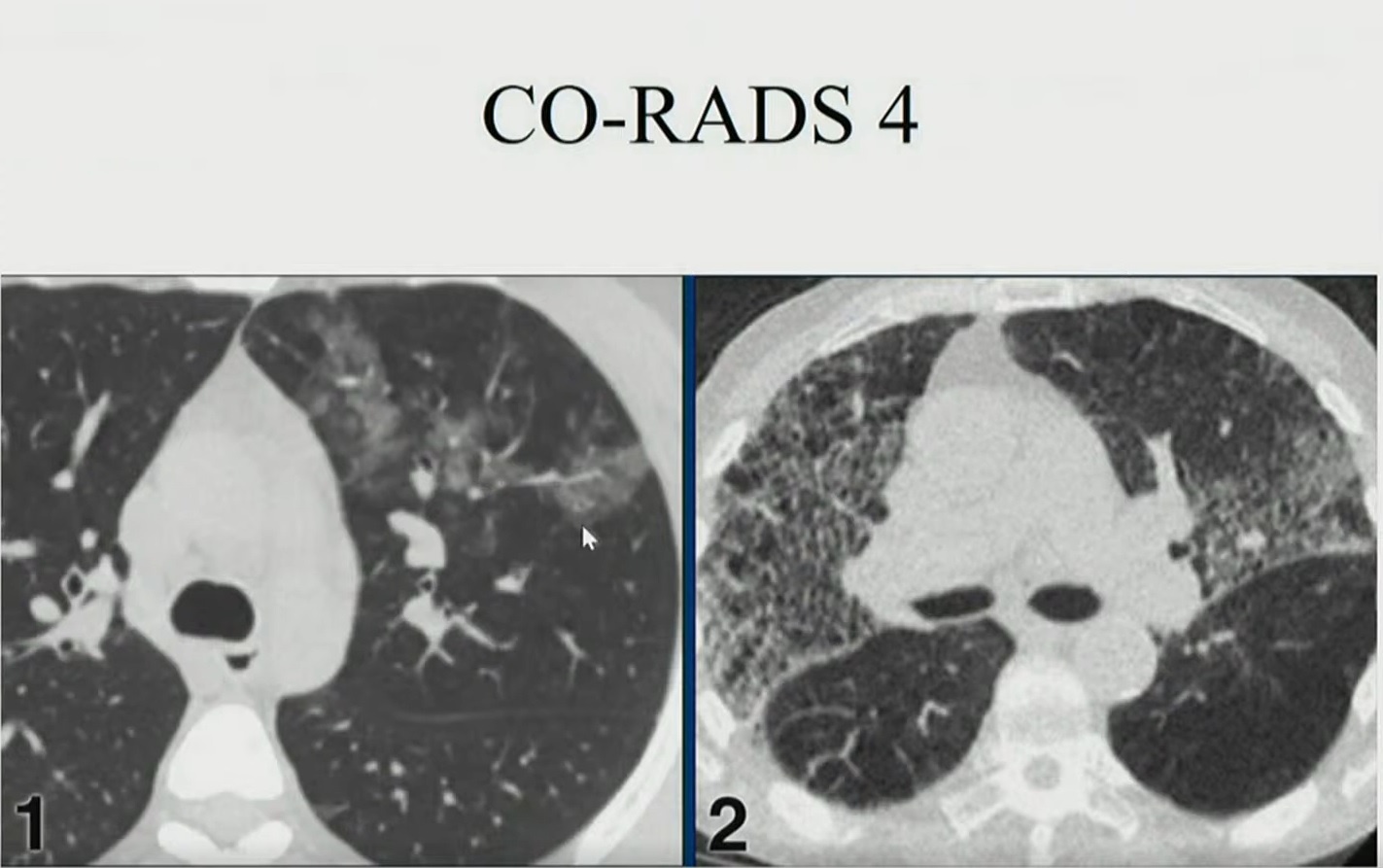 tổn thương phổi ảnh 4 ton thuong phoi anh 4