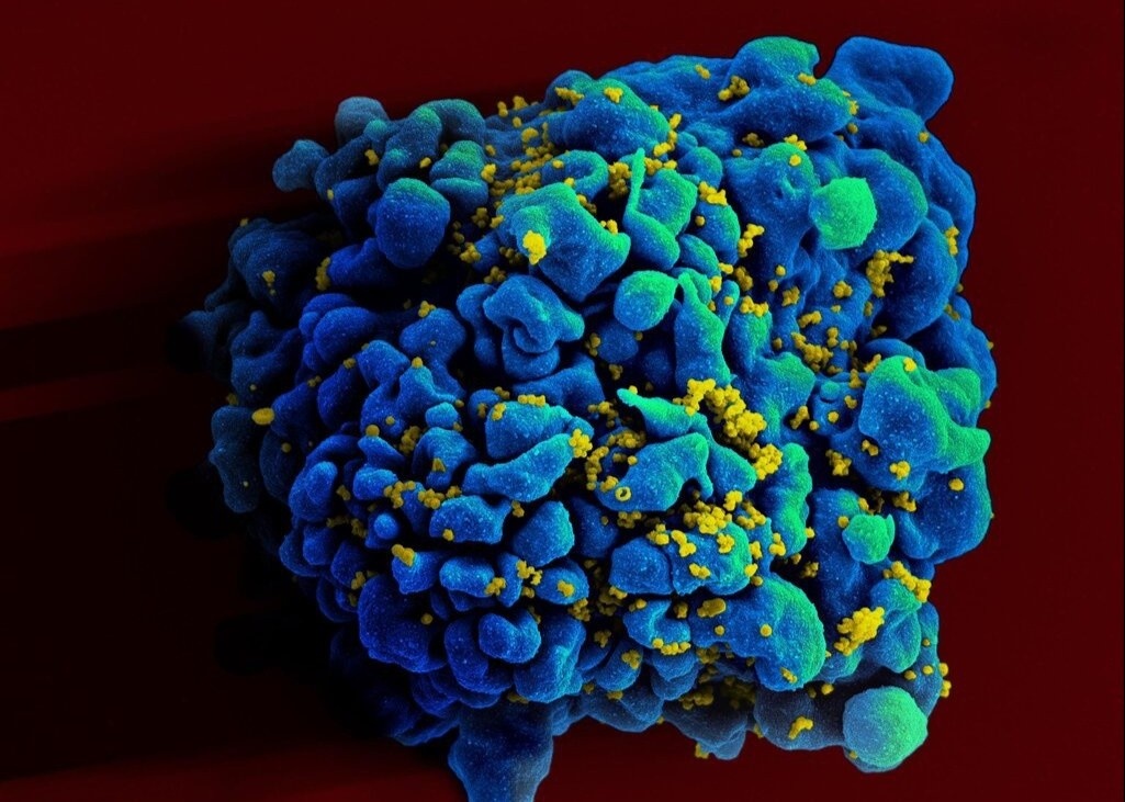 Benh nhan dau tien khoi HIV khong can dieu tri hinh anh