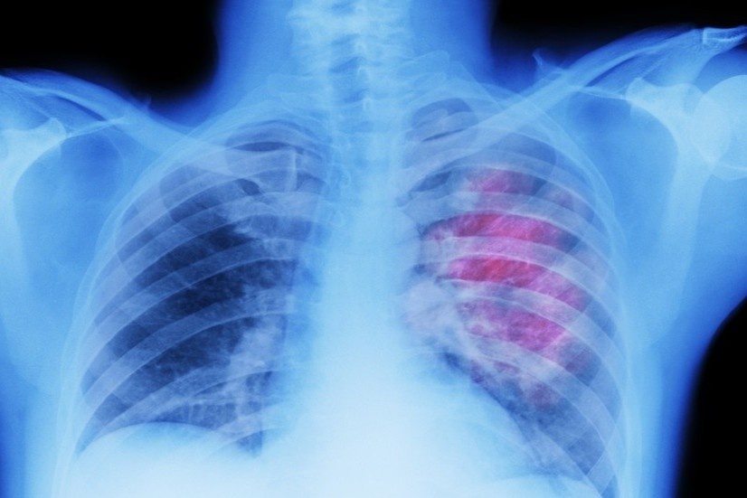 SARS-CoV-2 gay thung phoi benh nhan Covid-19 hinh anh