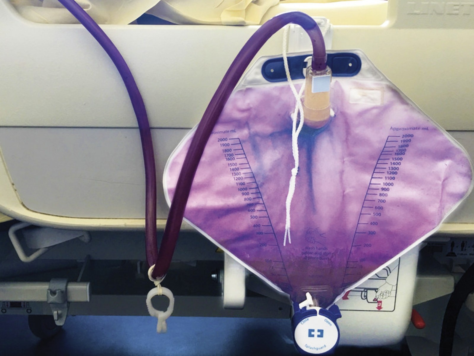 Hoi chung khien nuoc tieu chuyen mau tim hinh anh