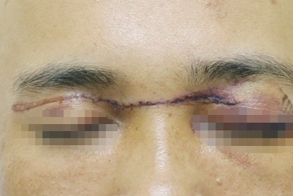 Nguoi dan ong bi rach mat vi va phai day dieu hinh anh