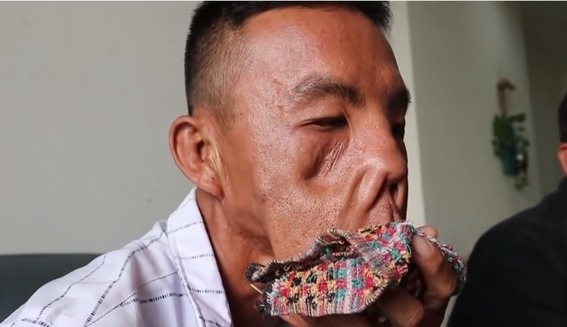 Can benh khien nguoi mac mang ‘khuon mat quy’ hinh anh